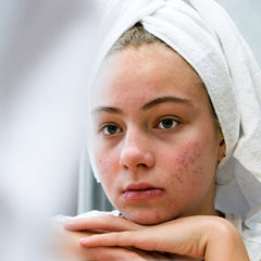 concern-skin-acne-prone